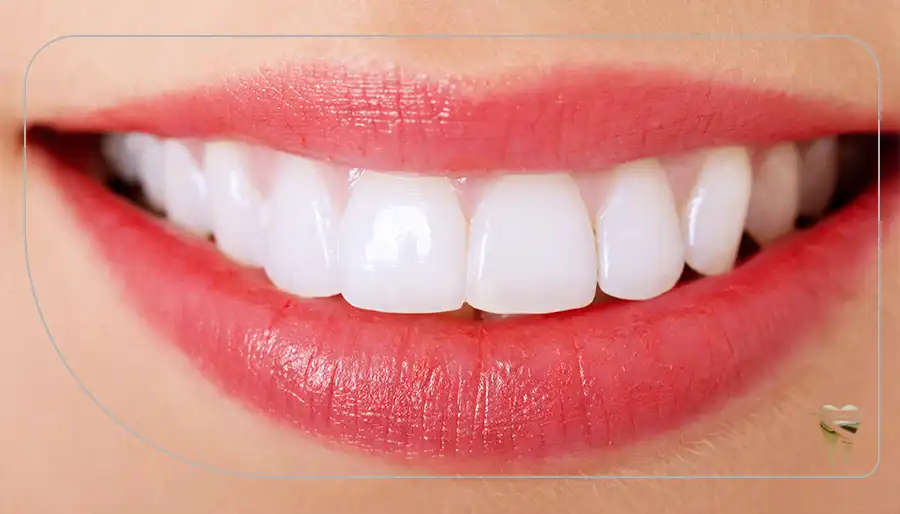 آیا لمینت دندان دائمی است؟_دندانپزشکی دکتر قاسمی
