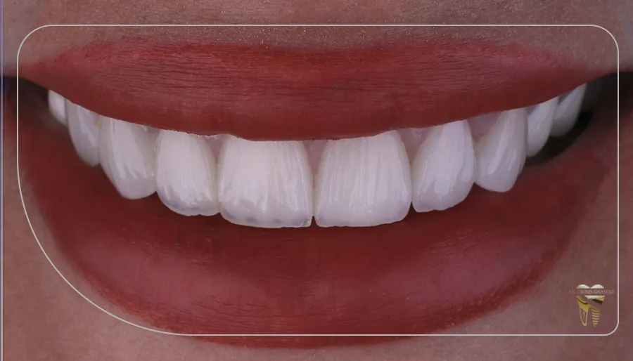 لمینت دندان فک بالا به چه صورت است؟