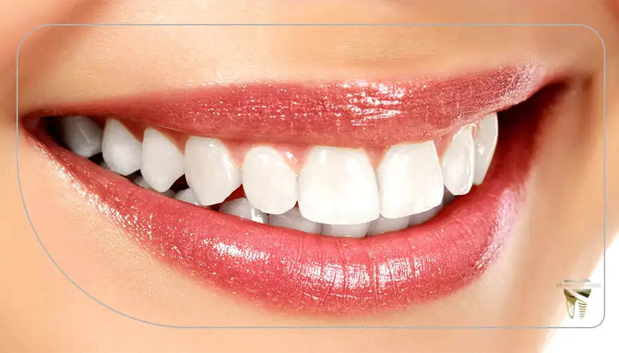 هر واحد لمینت دندان های بالا چند است؟