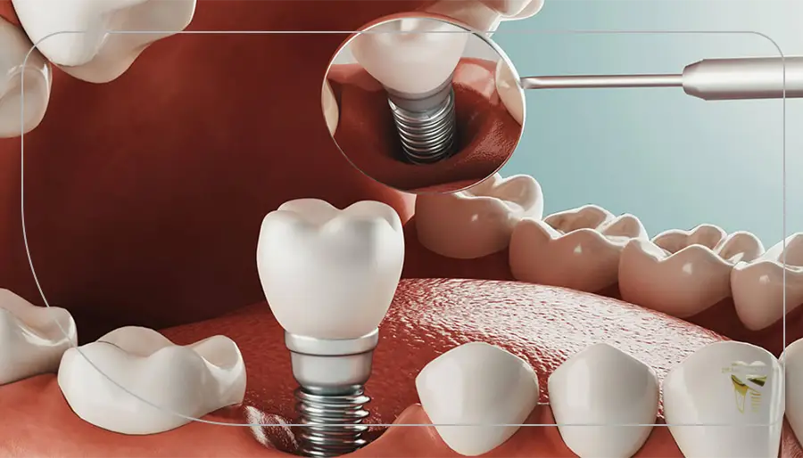 اهمیت استفاده از ایمپلنت دندان