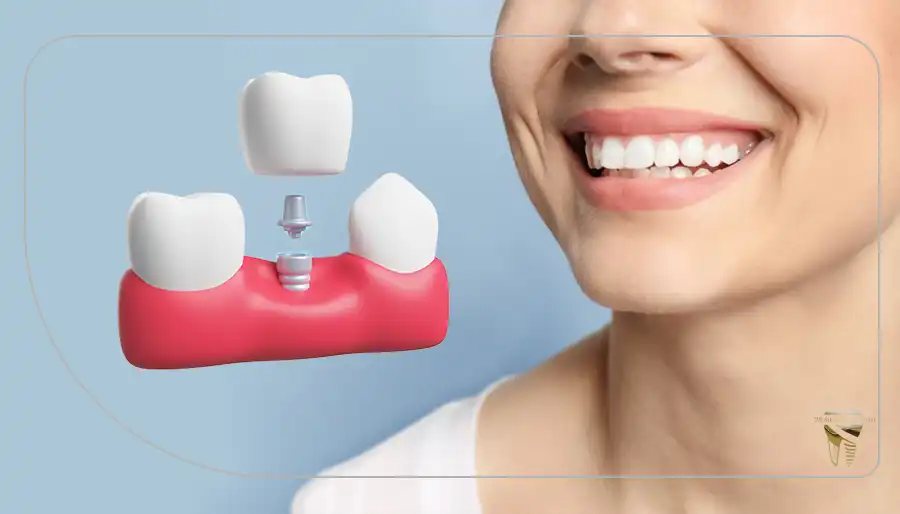 ایمپلنت دندان در شیراز - دندانپزشکی دکتر سیروس قاسمی