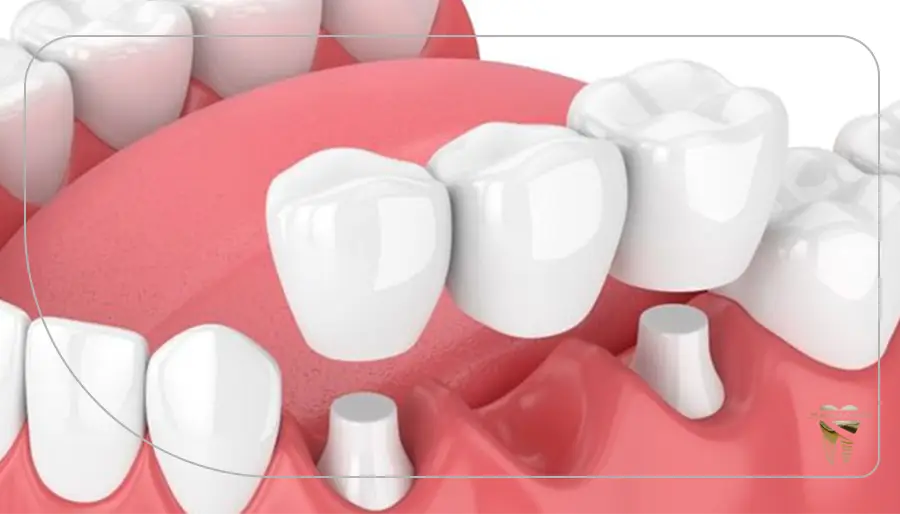  ایمپلنت یا بریج دندان،کدام روش بهتر است؟