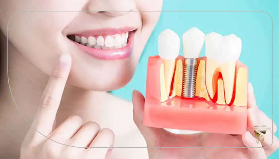 بهترین ایمپلنت دندان برای چه کسانی مناسب است؟