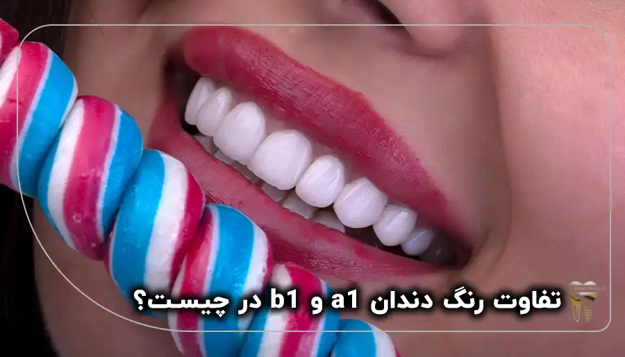 تفاوت رنگ دندان a1 و b1 در چیست؟_دندانپزشکی دکتر سیروس قاسمی