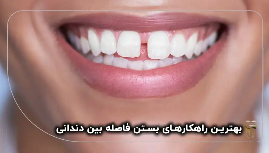 بستن فاصله بین دندانی