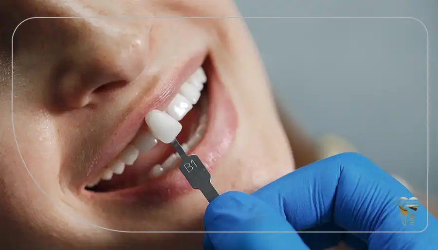 مراحل انجام لمینت دندان از صفر تا صد