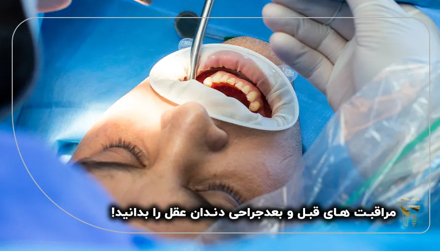 مراقبت های قبل و بعدجراحی دندان عقل