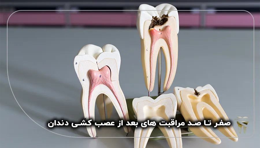 مراقبت های بعد از عصب کشی دندان