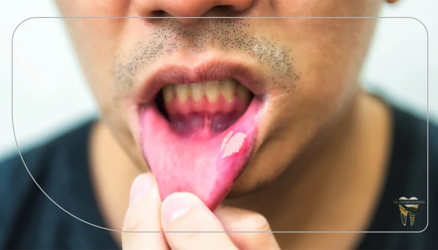 آفت دهان چه علائمی دارد؟