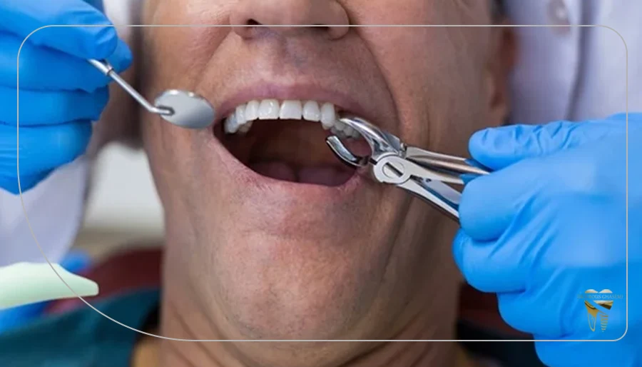 مزایا و معایب کشیدن دندان در ارتودنسی
