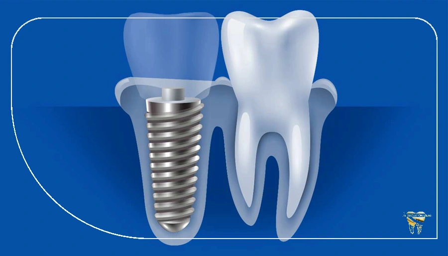 بررسی معایب و مزایا ایمپلنت دیجیتال دندان