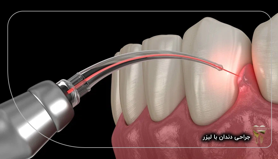جراحی دندان با لیزر