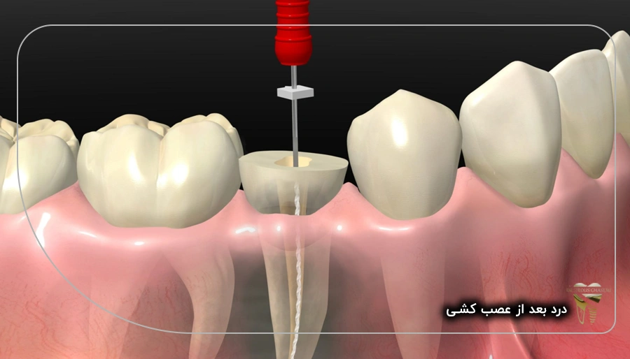 درد بعد از عصب کشی