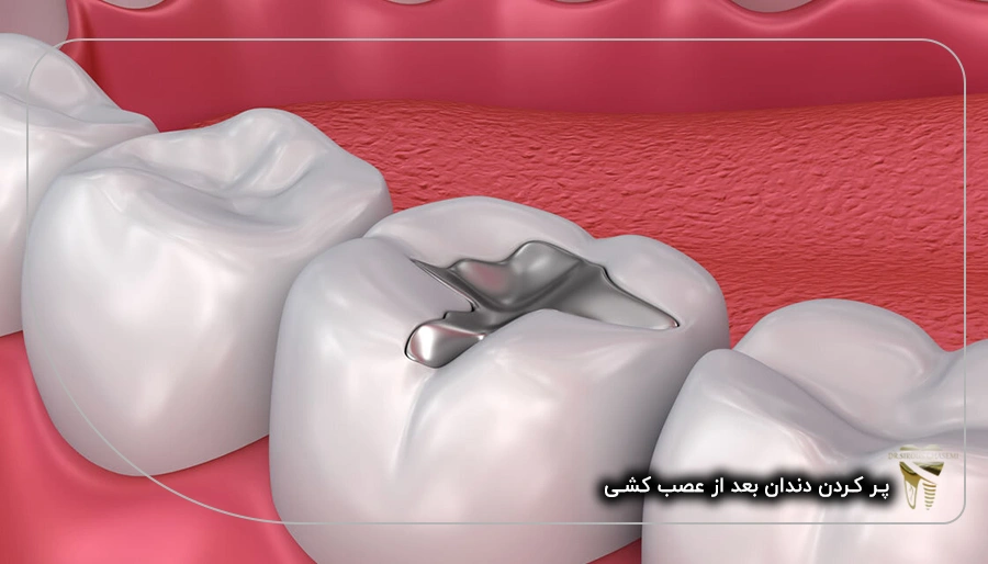 پر کردن دندان بعد از عصب کشی