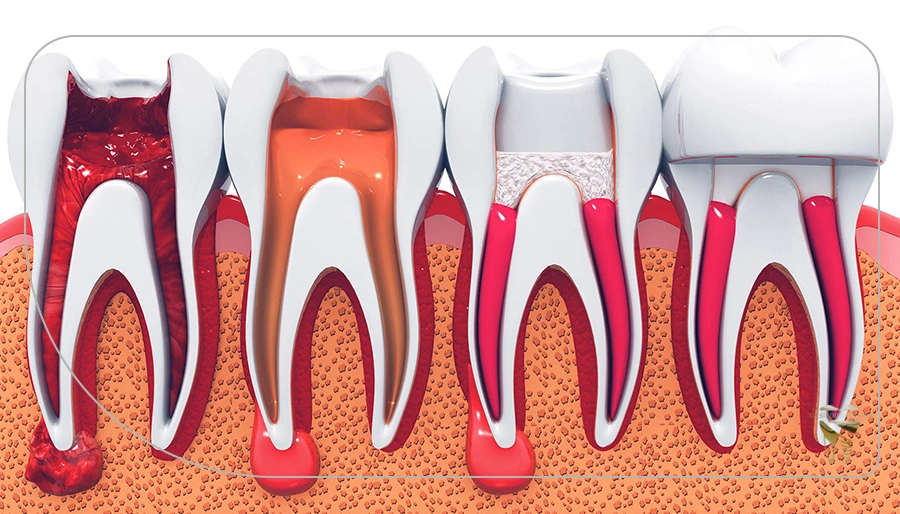 اثرات دندان خراب بر روی سلامت کلی بدن