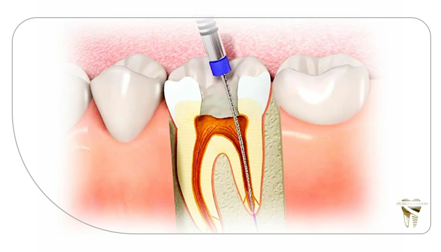 راهکارهای درمانی برای دندان‌های شکسته عصب‌کشی شده