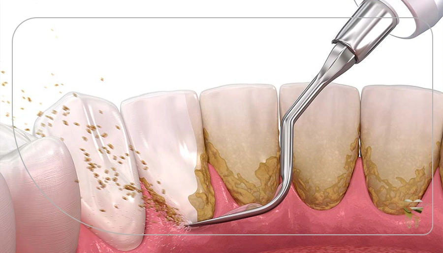 چگونه از تشکیل جرم و پلاک دندان جلوگیری کنیم؟