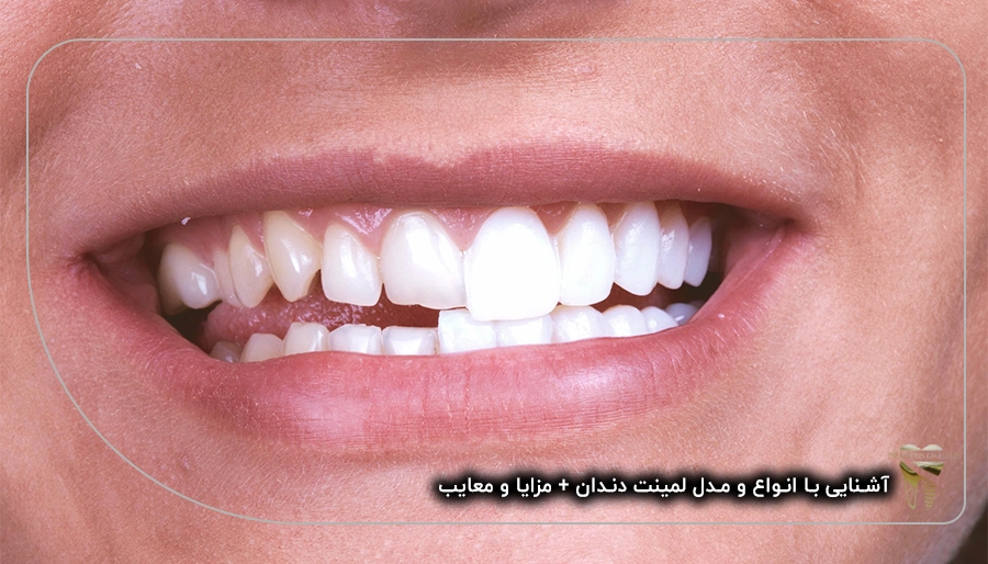 آشنایی با انواع و مدل لمینت دندان