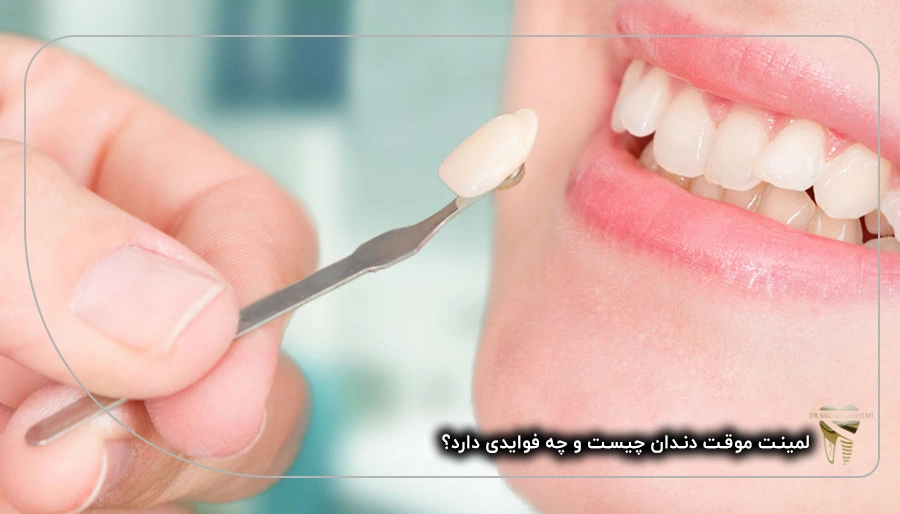 لمینت موقت دندان چیست