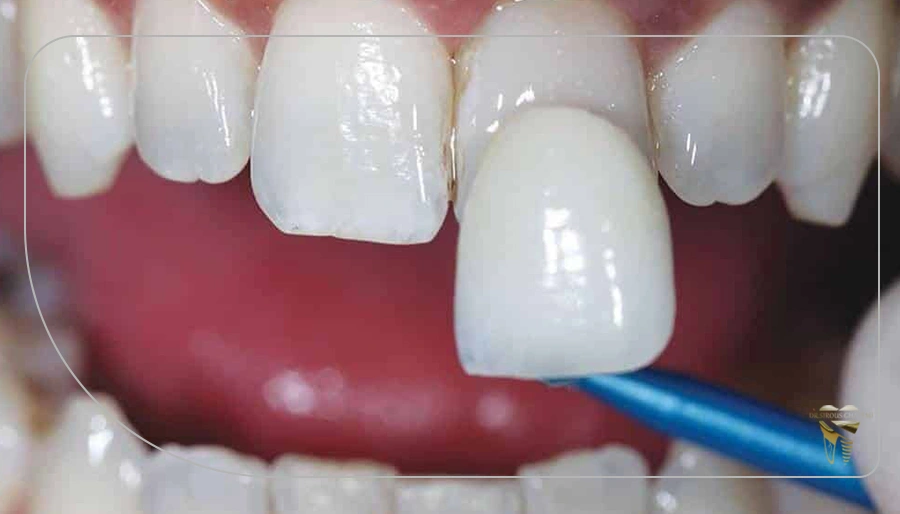 چگونه از لمینت دندان مراقبت کنیم
