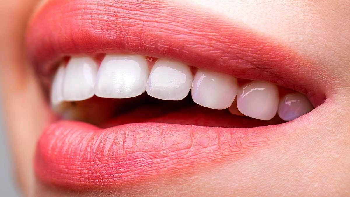 روش‌های افزایش ماندگاری لمینت دندان