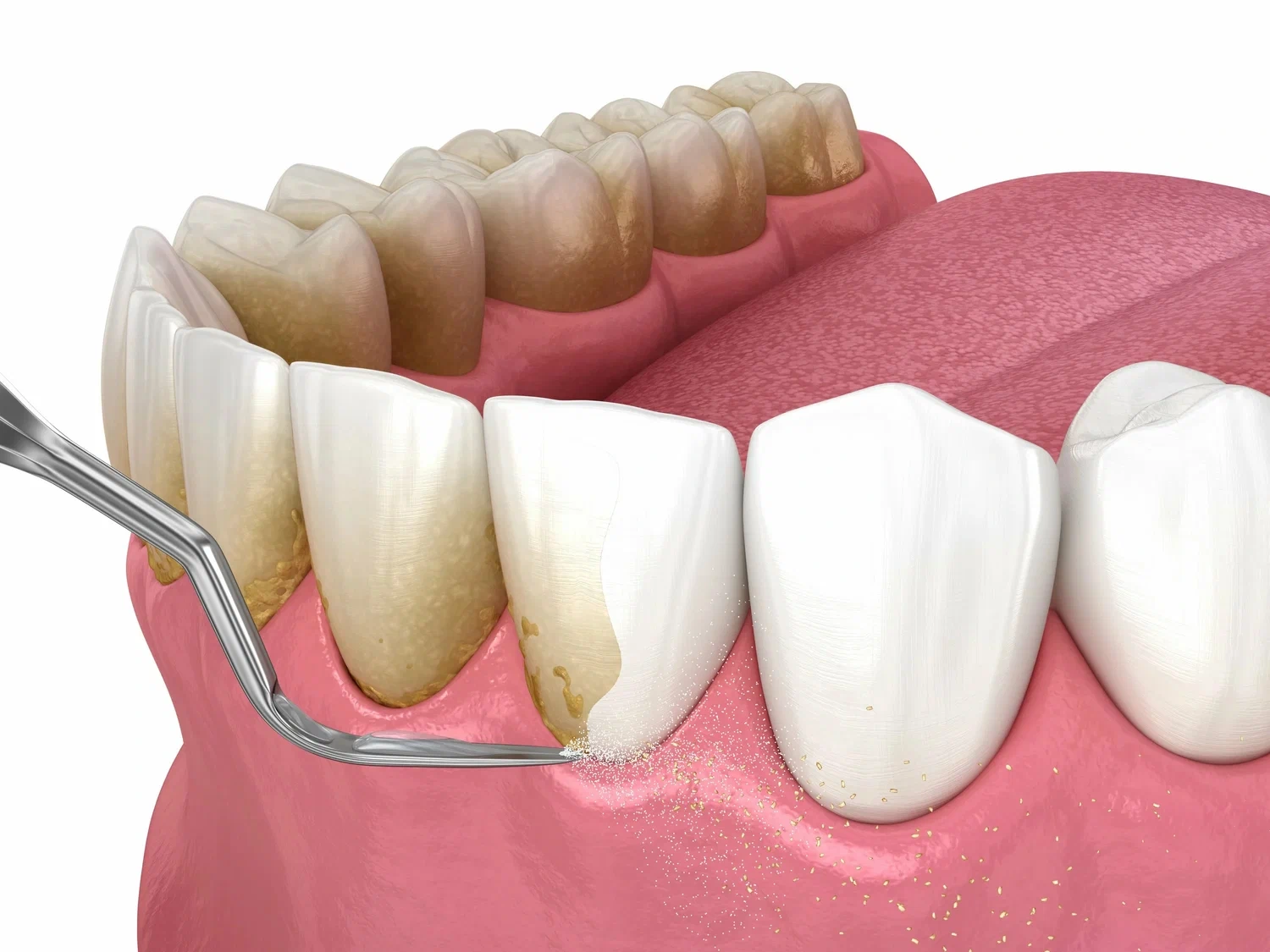 آیا انجام لمینت دندان پایین ضروری است؟