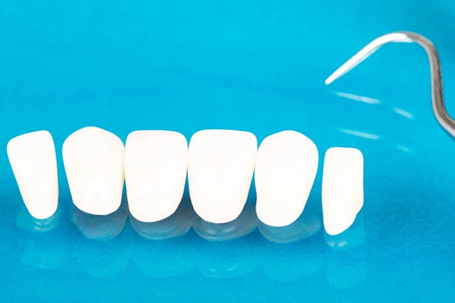 راهکارهای افزایش طول عمر و دوام لمینت دندان