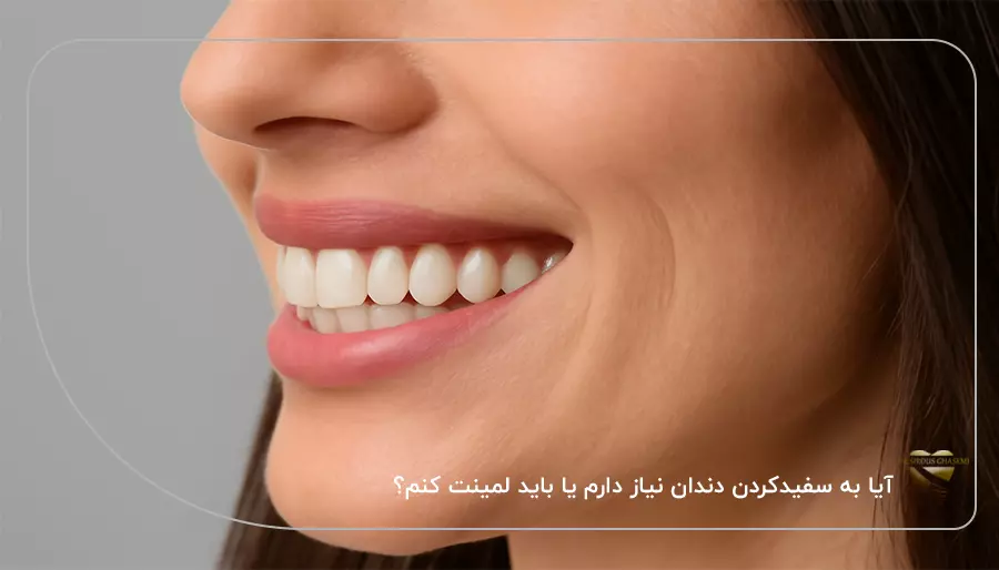 آیا به سفیدکردن دندان نیاز دارم یا باید لمینت کنم؟