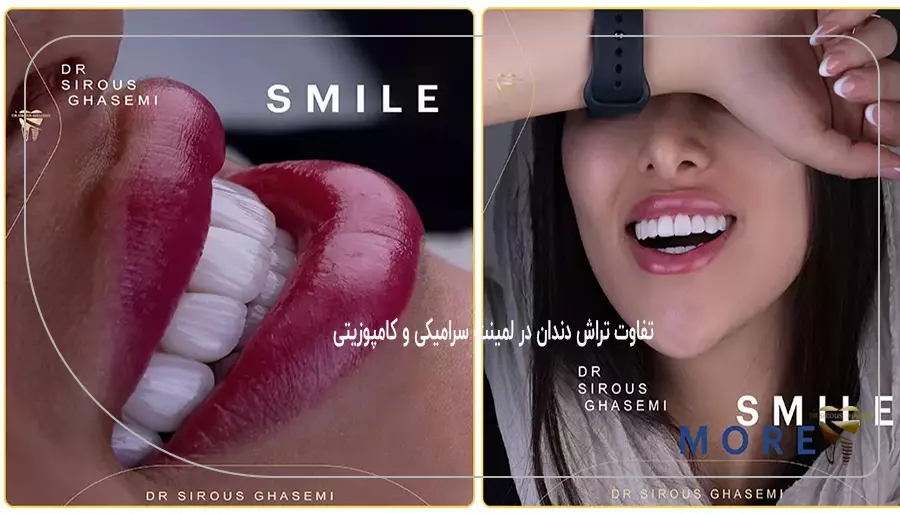 تفاوت تراش دندان در لمینت سرامیکی و کامپوزیتی