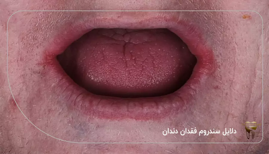 دلایل سندروم فقدان دندان