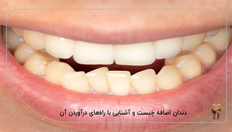دندان اضافه چیست و آشنایی با راه‌های درآوردن آن