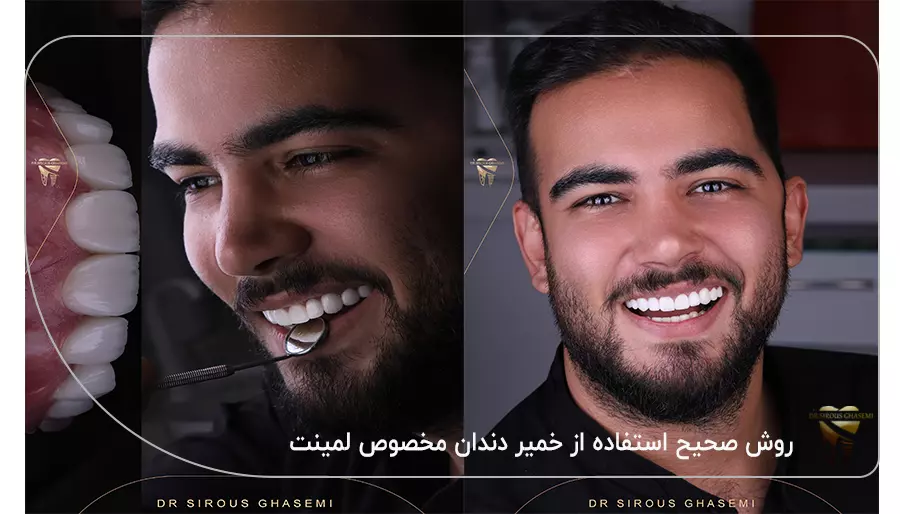 روش صحیح استفاده از خمیر دندان مخصوص لمینت