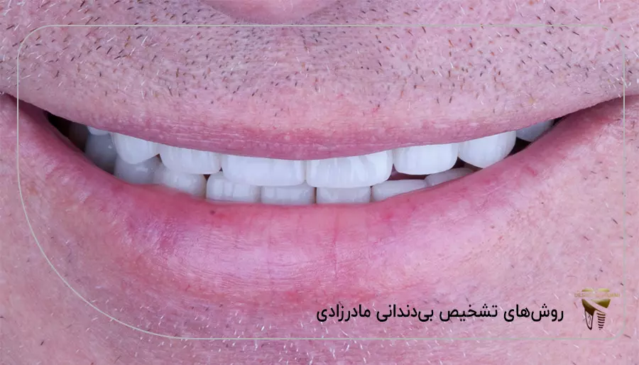 روش‌ های تشخیص بی‌ دندانی مادر زادی
