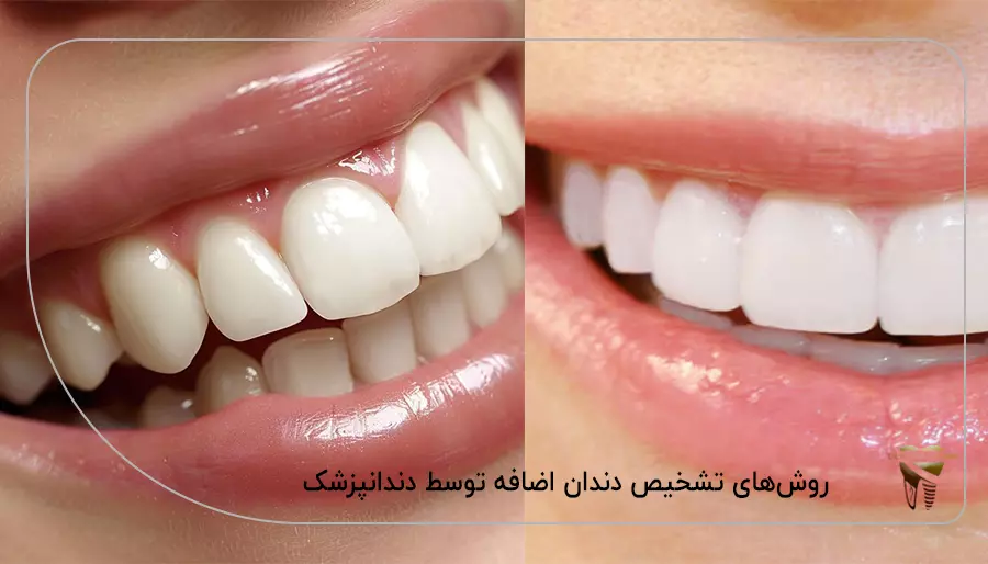 روش‌ های تشخیص دندان اضافه توسط دندانپزشک