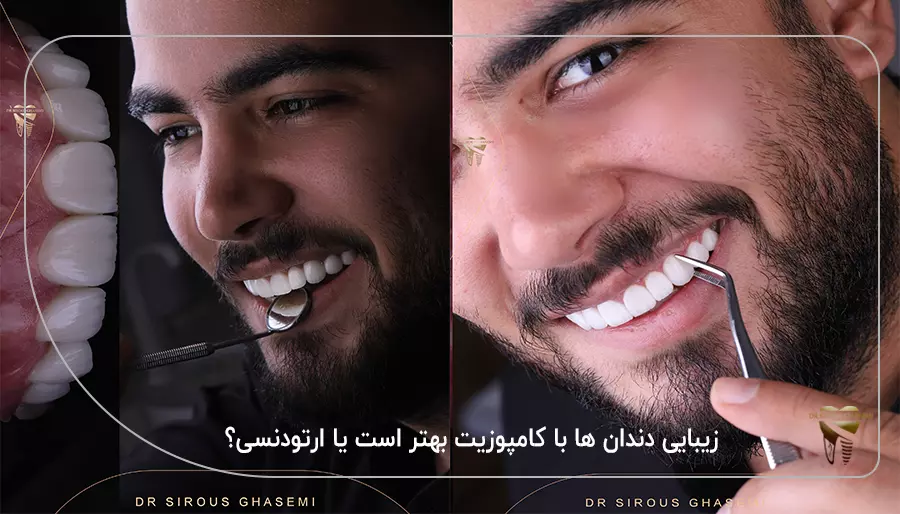 زیبایی دندان ها با کامپوزیت بهتر است یا ارتودنسی؟