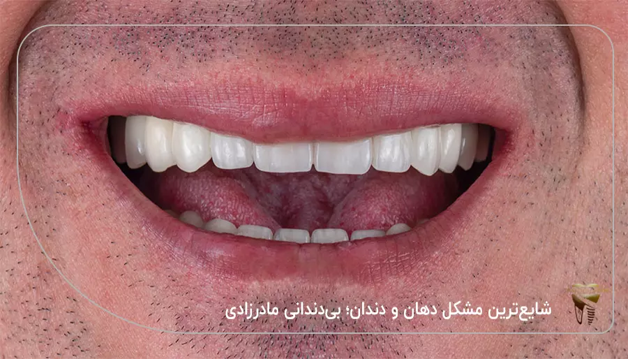 شایع‌ ترین مشکل دهان و دندان؛ بی‌ دندانی مادر زادی