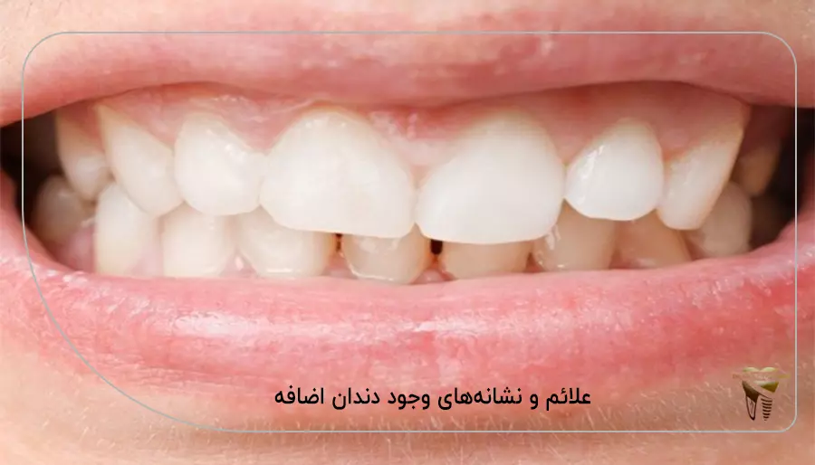 علائم و نشانه‌ های وجود دندان اضافه