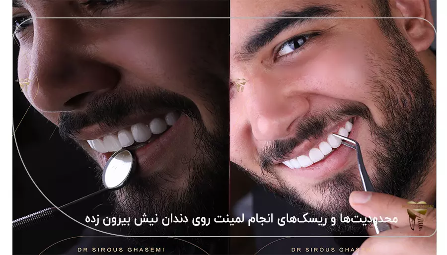 محدودیت‌ها و ریسک‌های انجام لمینت روی دندان نیش بیرون زده