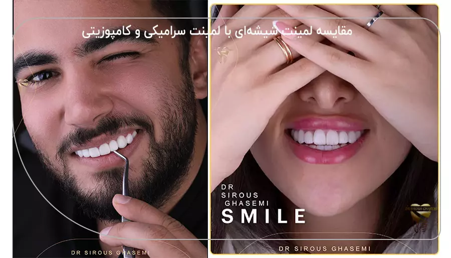 مقایسه لمینت شیشه‌ای با لمینت سرامیکی و کامپوزیتی