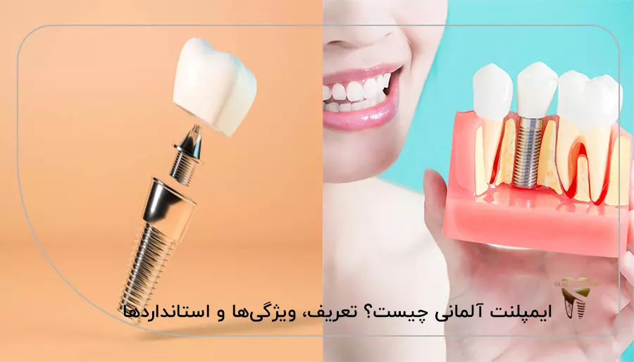ایمپلنت آلمانی چیست؟ تعریف، ویژگی‌ها و استانداردها