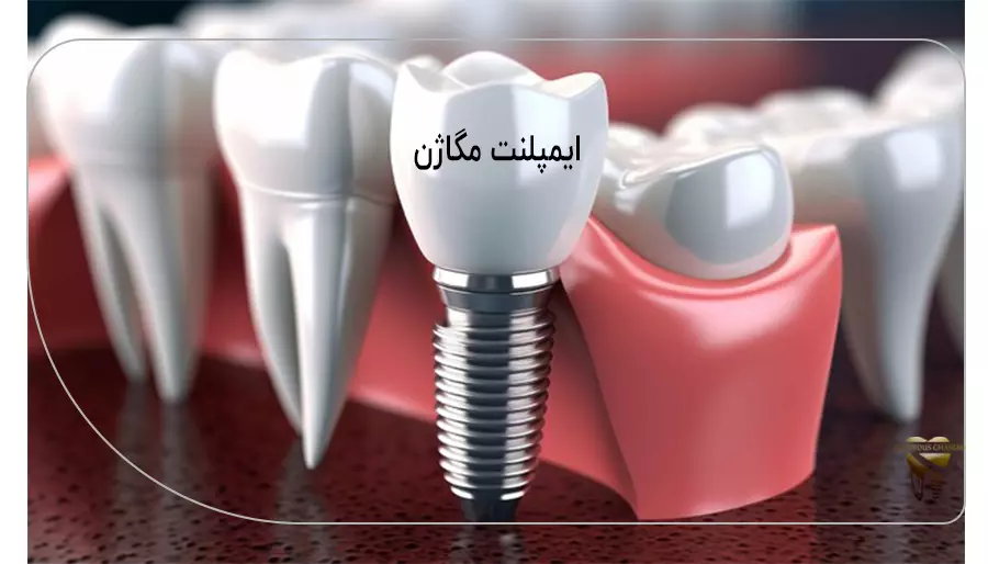ایمپلنت مگاژن