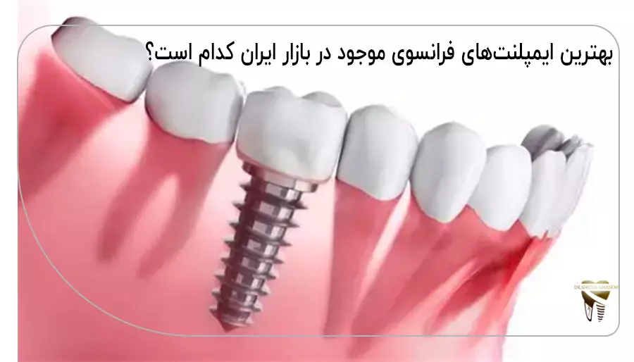 بهترین ایمپلنت‌های فرانسوی موجود در بازار ایران کدام است؟