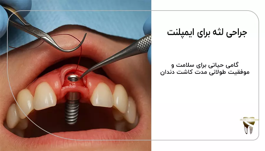 جراحی لثه برای ایمپلنت