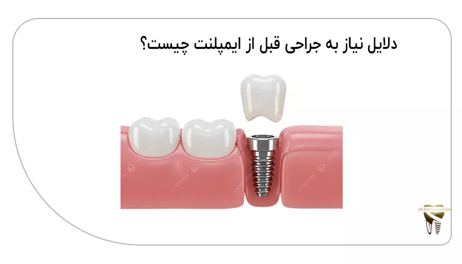دلایل نیاز به جراحی قبل از ایمپلنت چیست؟