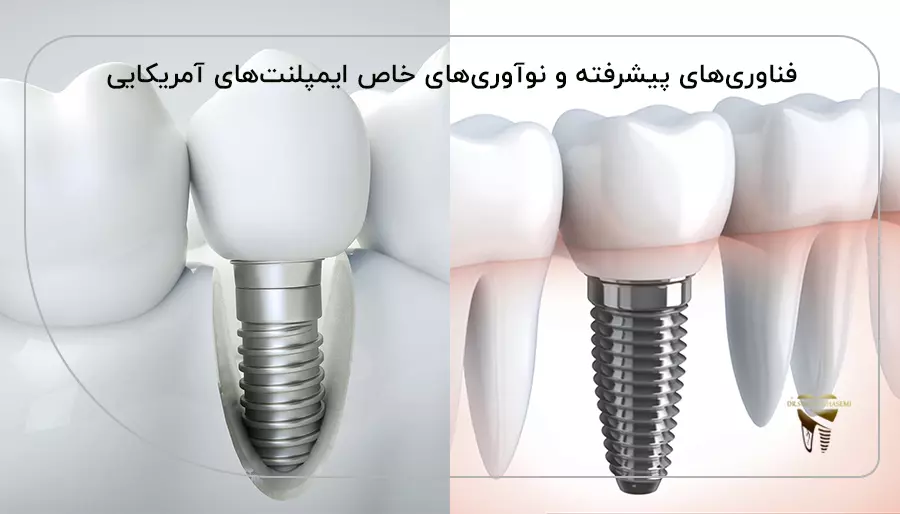 فناوری‌های پیشرفته و نوآوری‌های خاص ایمپلنت‌های آمریکایی