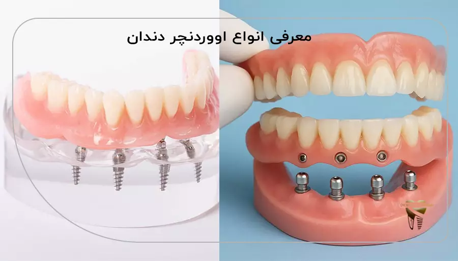 معرفی انواع اووردنچر دندان