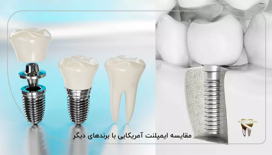 مقایسه ایمپلنت آمریکایی با برندهای دیگر
