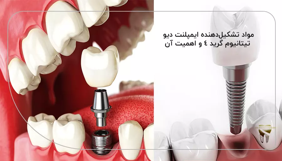 مواد تشکیل‌دهنده ایمپلنت دیو