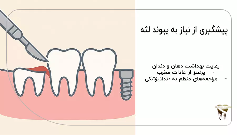 پیشگیری از نیاز به پیوند لثه