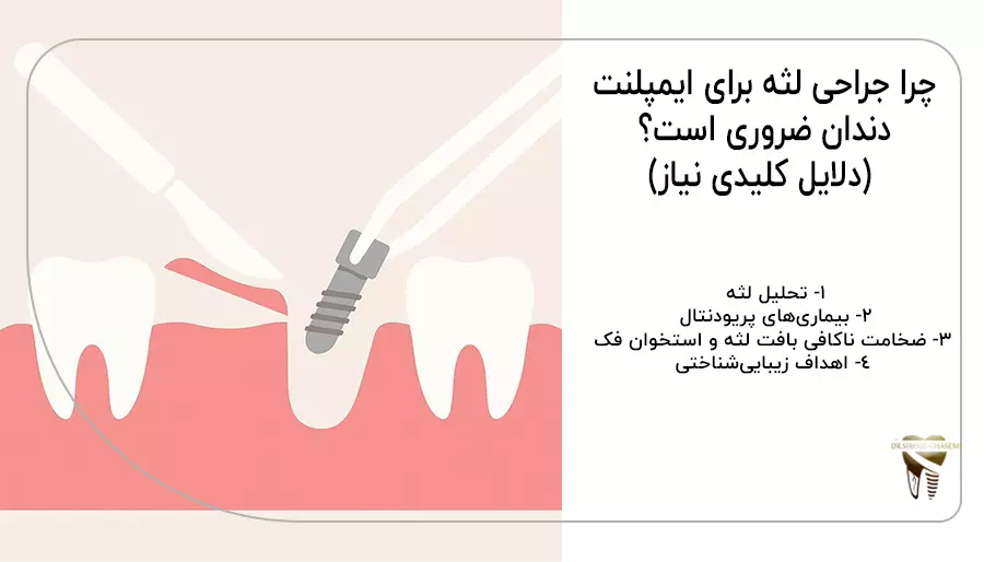 چرا جراحی لثه برای ایمپلنت ضروری است